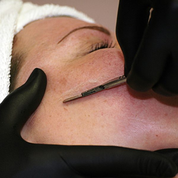 image-13-dermaplane
